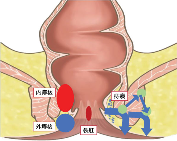 肛門の3大疾患