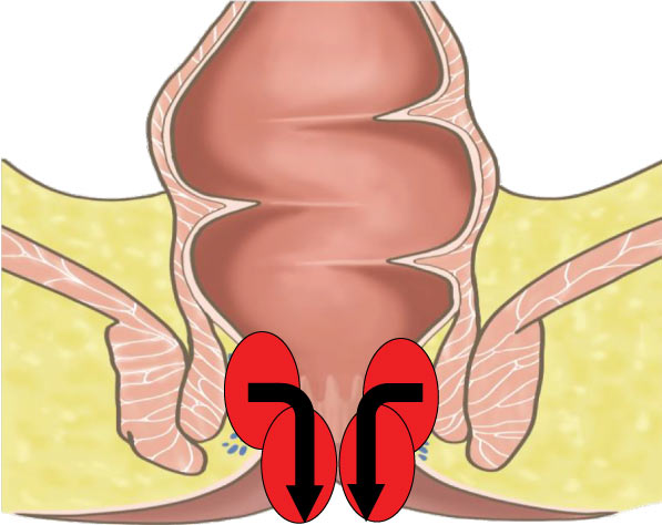 2度痔核　排便時