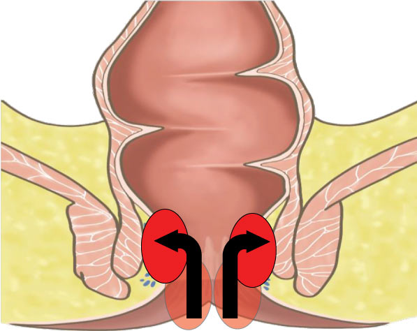 2度痔核　排便後