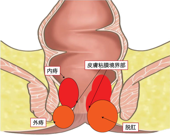 いぼ痔（痔核）