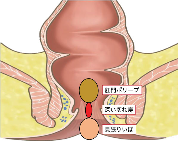 慢性裂肛