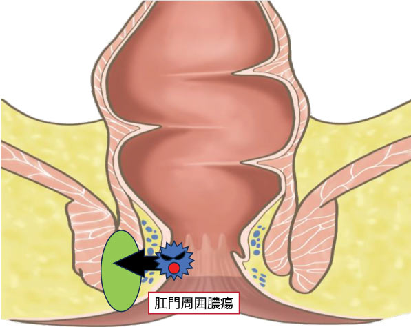 肛門周囲膿瘍